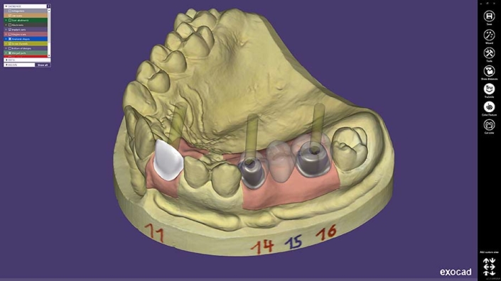 CAD Software - exocad