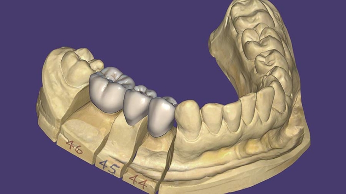 CAD Software - exocad
