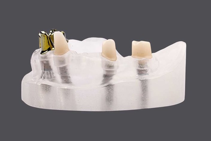 Individuelle Abutments
